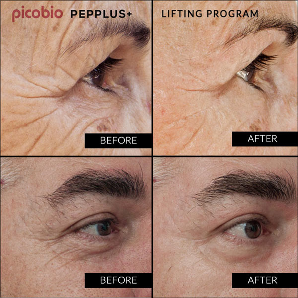 PicoBio PEPPLUS+ Special SkinCare Lifting Program – 1 treatment