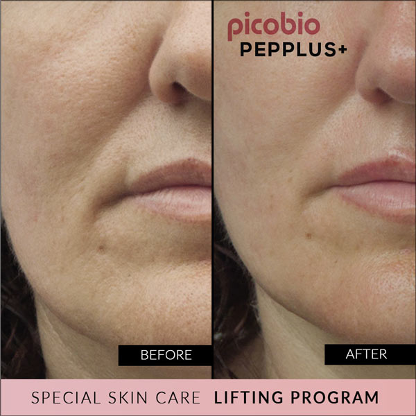 PicoBio PEPPLUS+ Special SkinCare Lifting Program – 1 treatment